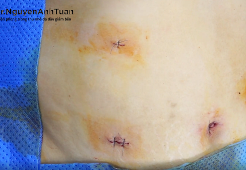 Sự khác biệt giữa phẫu thuật nội soi và mổ mở truyền thống trong phẫu thuật thu nhỏ dạ dày là gì?